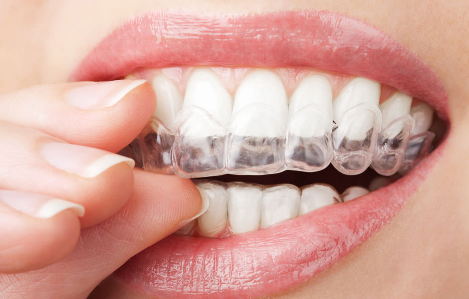 Ortodoncia invisilign tratamientos dentales clinicadentaldoriamedina