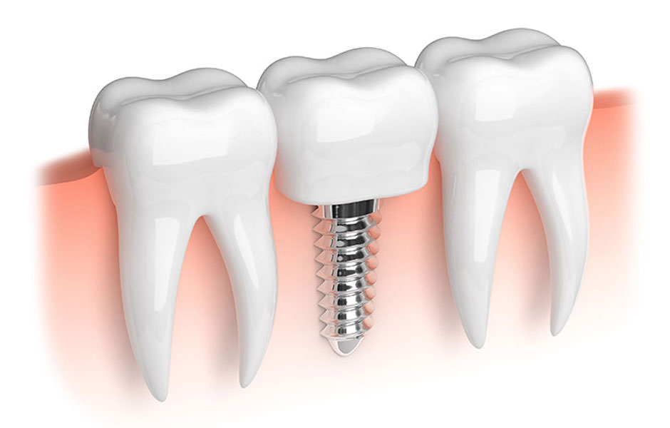 implantes-tratamientos-dentales-02-clinicadentaldoriamedina