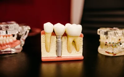 Tipos de Prótesis Dental